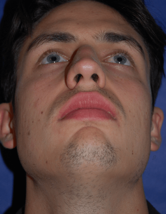 42+ Nasen op heilungsverlauf bilder , Patientenbegleitung Nasen OP Heilungsverlauf Bilder